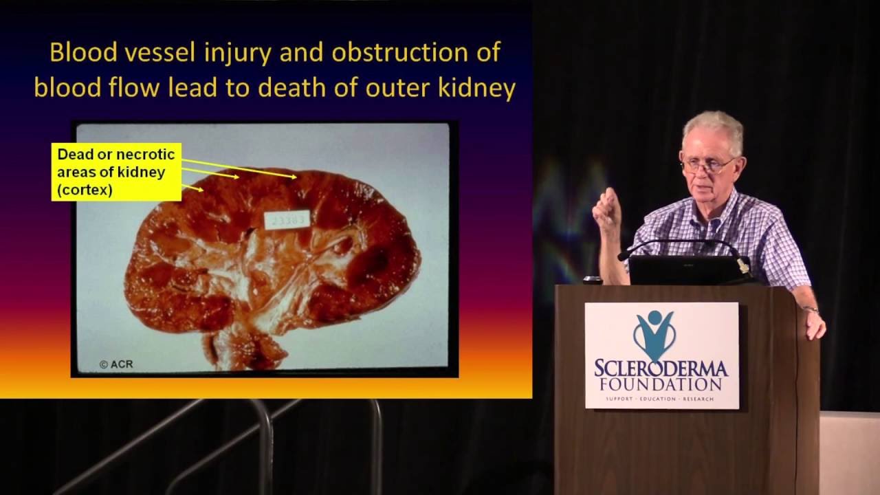 2015 Nashville- Kidney Involvements in Systemic Sclerosis- Dr. Philip Clements