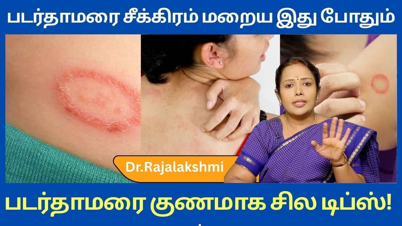 படர்தாமரை சீக்கிரம் மறைய இது போதும் | Ringworm treatement in tamil |Dr.Rajalakshmi | ASM INFO
