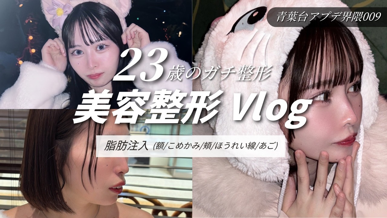 【脂肪注入5箇所】顔面フル脂肪注入のダウンタイム記録｜切らない輪郭形成でコケ顔改善
