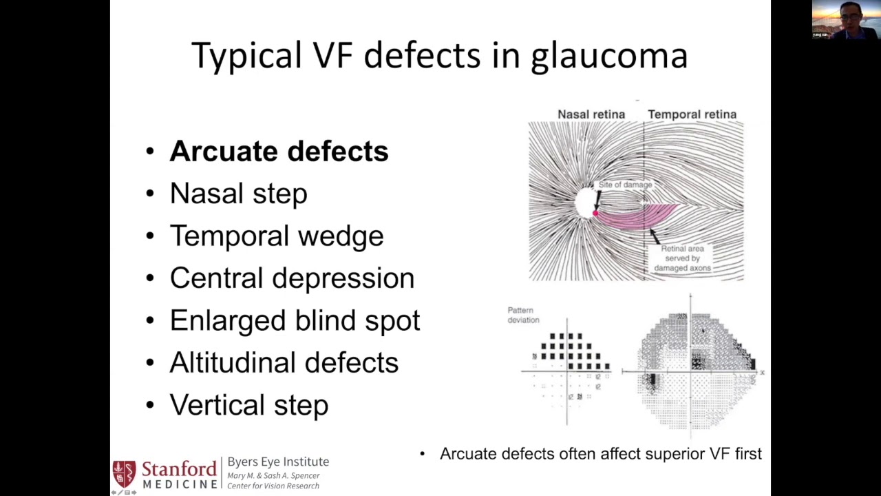 Clinical Presentation and History - Mechanism of vision loss in glaucoma