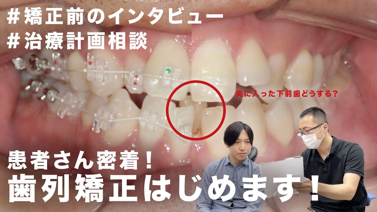 【矯正密着EP1】矯正前インタビュー / 治療計画を伝える【ガタガタ・開咬・出っ歯の治し方】