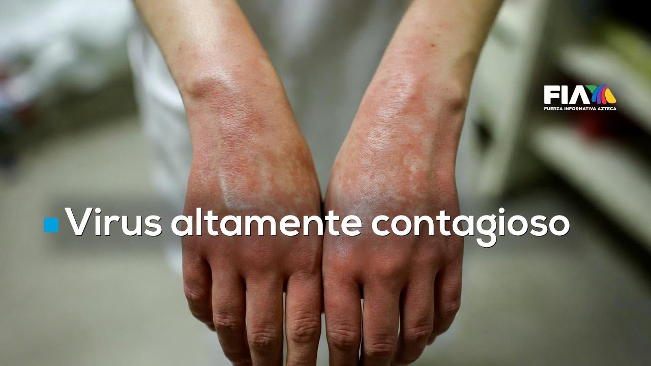 Sarampi&oacute;n avanza: M&eacute;xico est&aacute; en riesgo de perder su certificaci&oacute;n de pa&iacute;s libre de la enfermedad