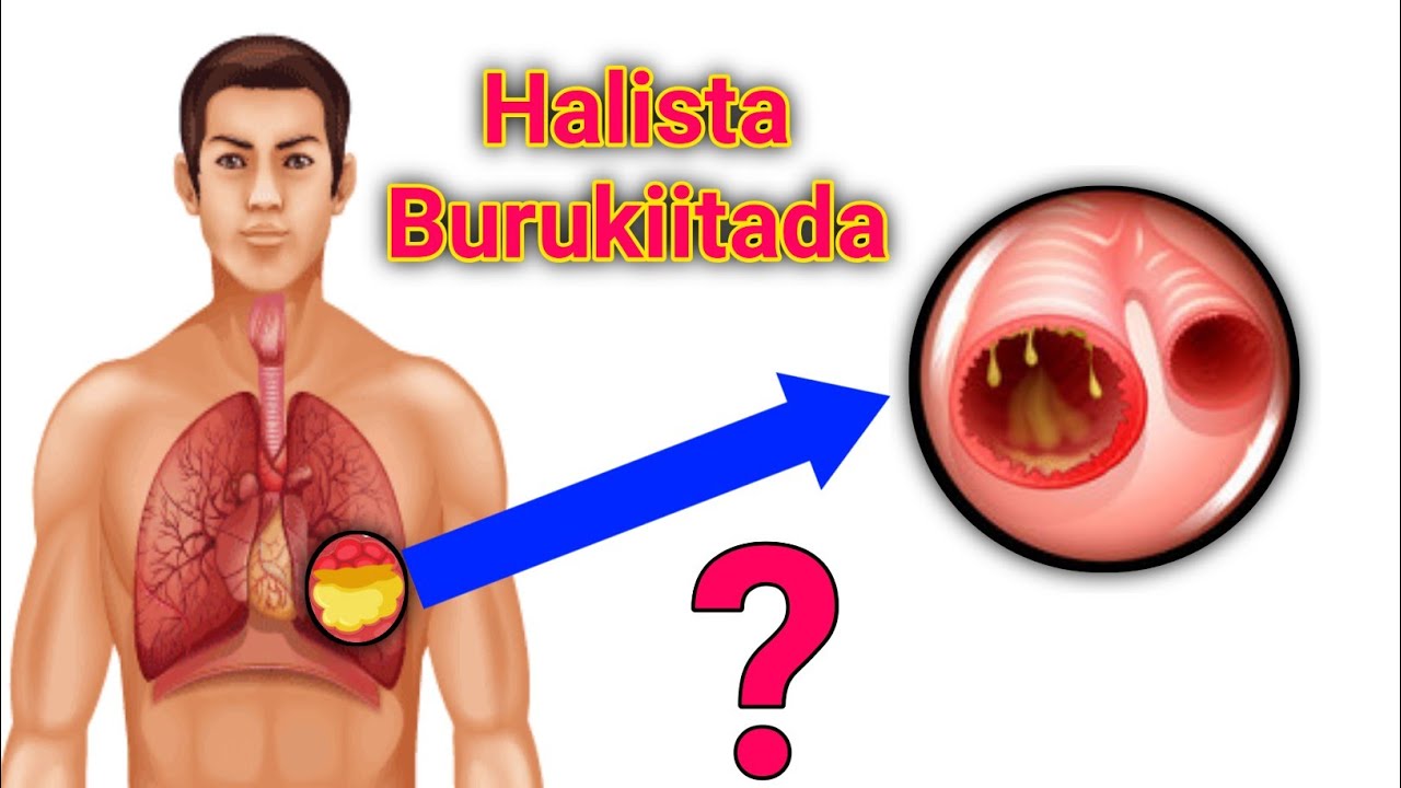 Burukiitada waxa Sababo iyo talooyin muhiim ah....