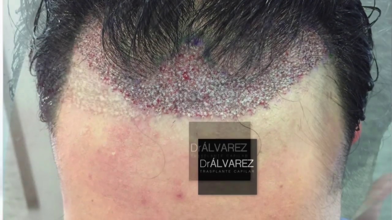 Injerto capilar | Dr Xavier Álvarez | Técnica Fue |1.742 unidades foliculares (4.006 cabellos)