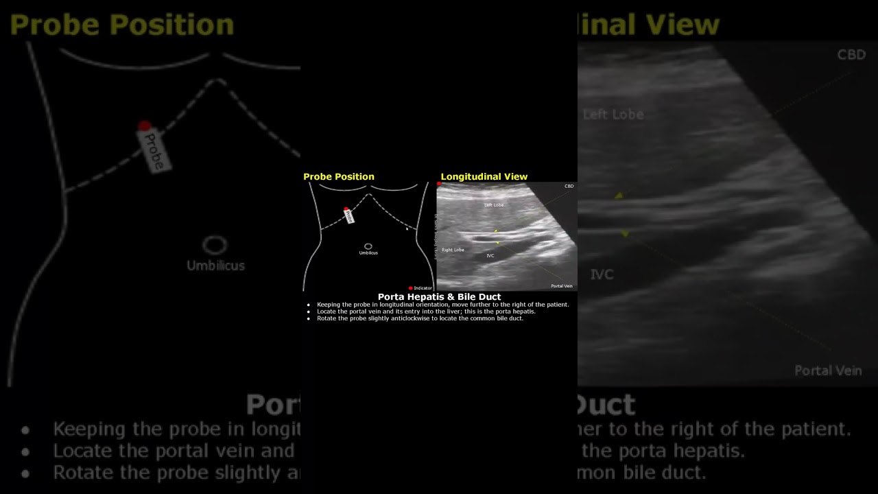 Caudate Lobe, Porta Hepatis, CBD Probe Positioning | Liver Ultrasound Transducer Placement |#shorts