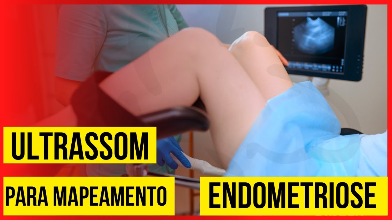 Ultrassom para Mapeamento de ENDOMETRIOSE: Valor? Onde fazer?