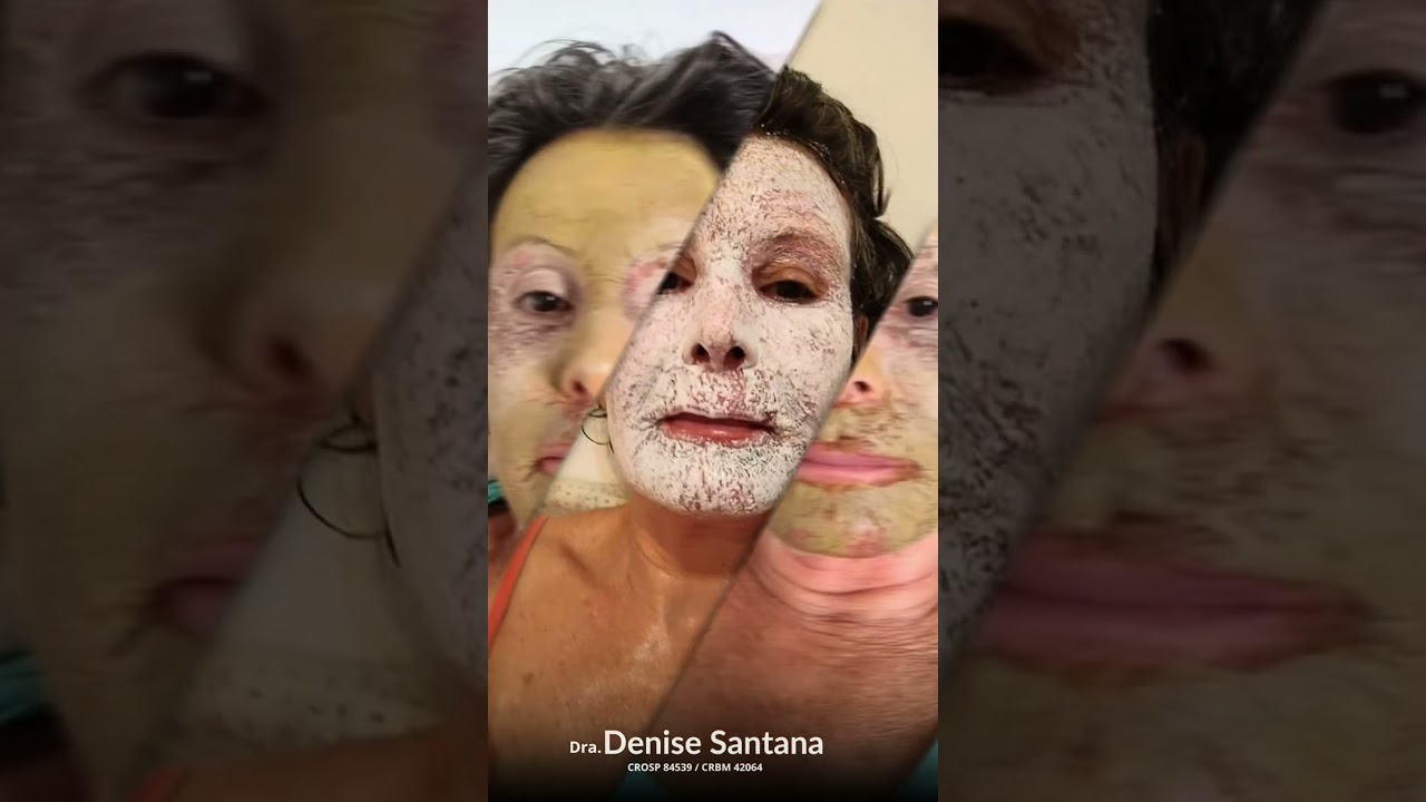 PEELING ATA CRÓTON | ESTETICA FACIAL | DRA DENISE SANTANA