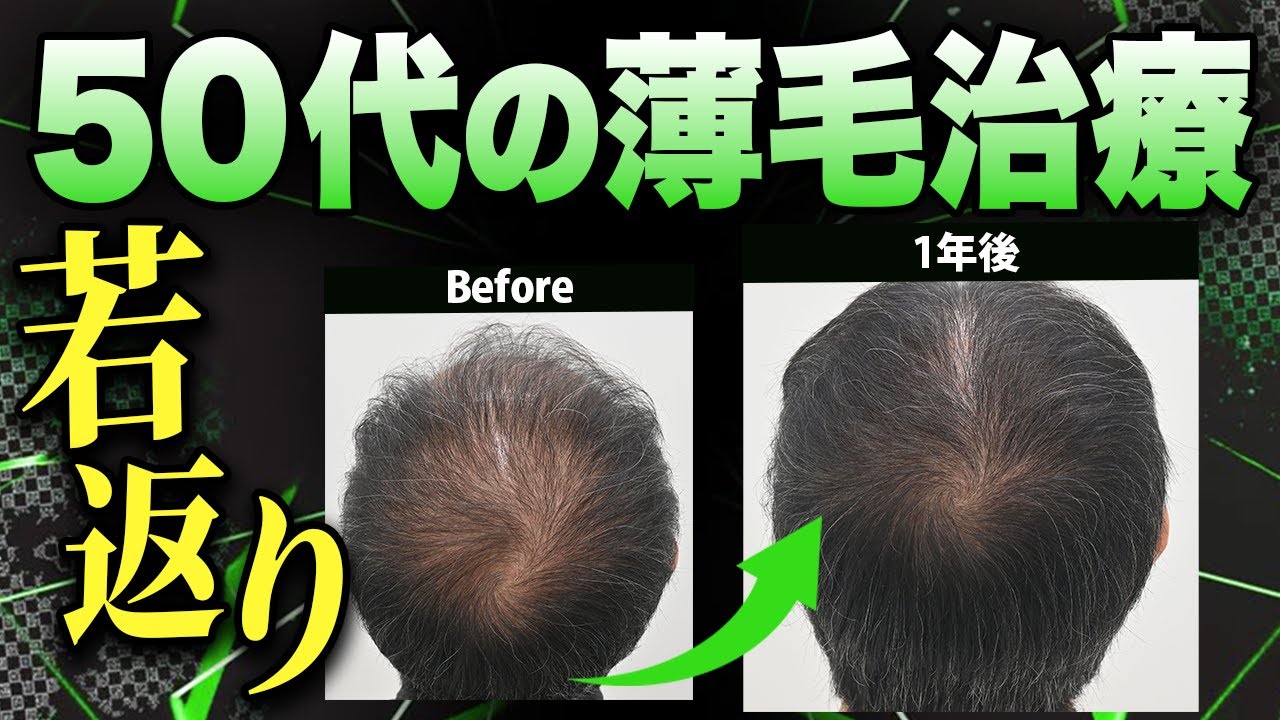 50代からでも髪は生える？年齢と治療効果のリアル