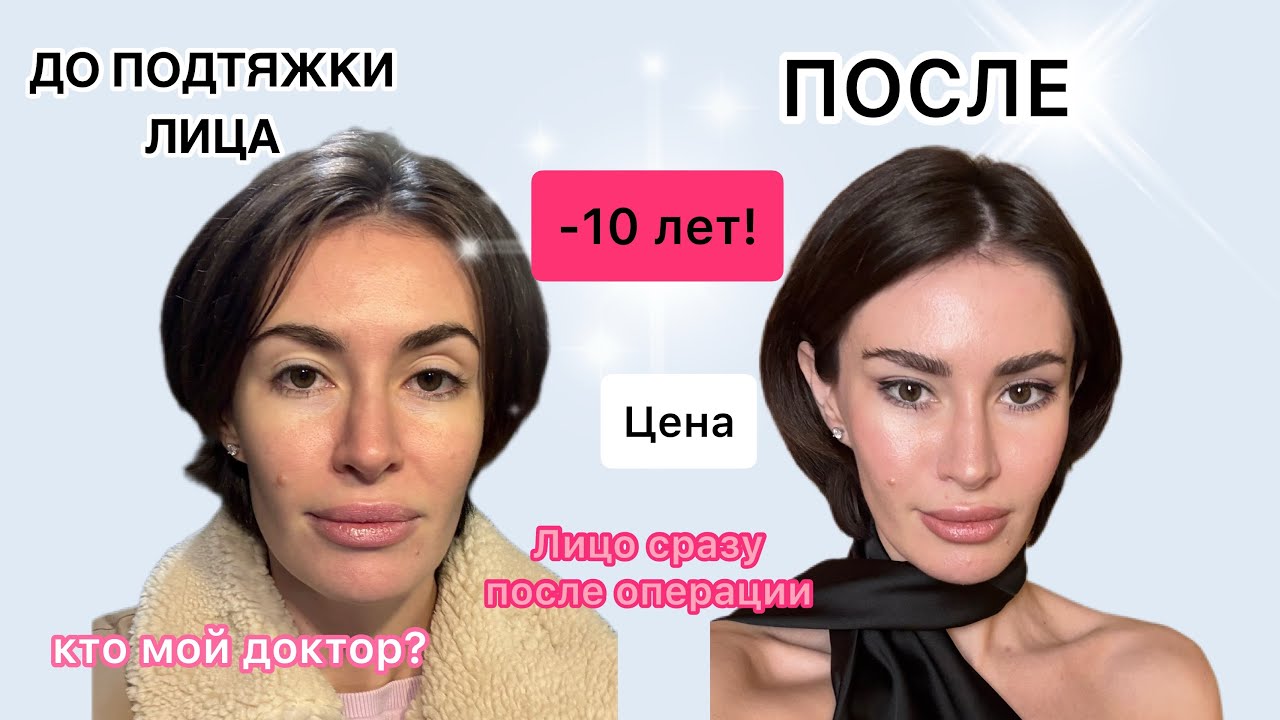 Подтяжка лица в 31 год. Зачем так рано?  Кто мой врач? Сколько стоит?