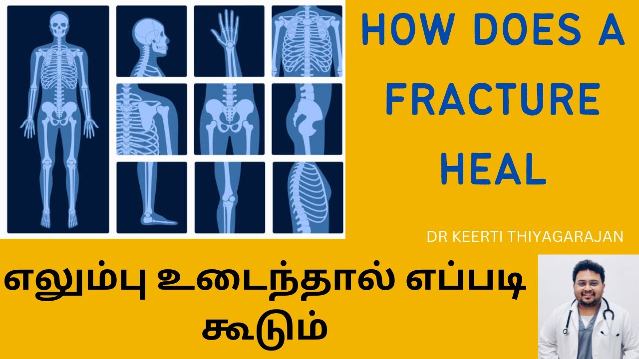 FRACTURE HEALING TECHNIQUE AND PATTERN /எலும்பு உடைந்தால் எப்படி கூடும்