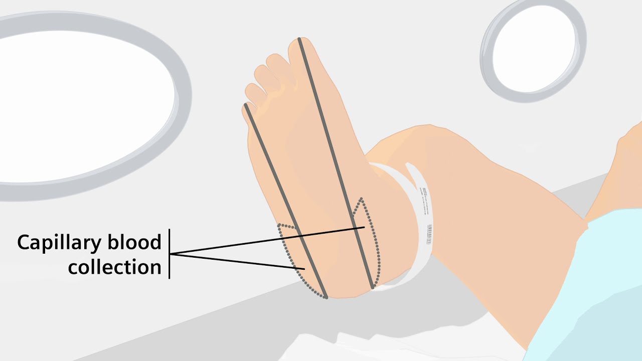 How to properly handle a capillary blood gas sample