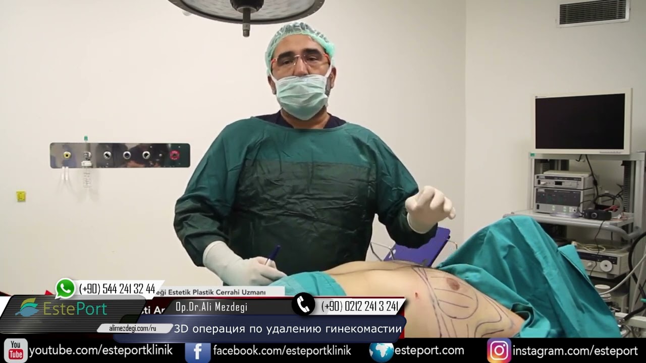 3D-операция при гинекомастии: без разрезов на сосках | Живой пример пациента
