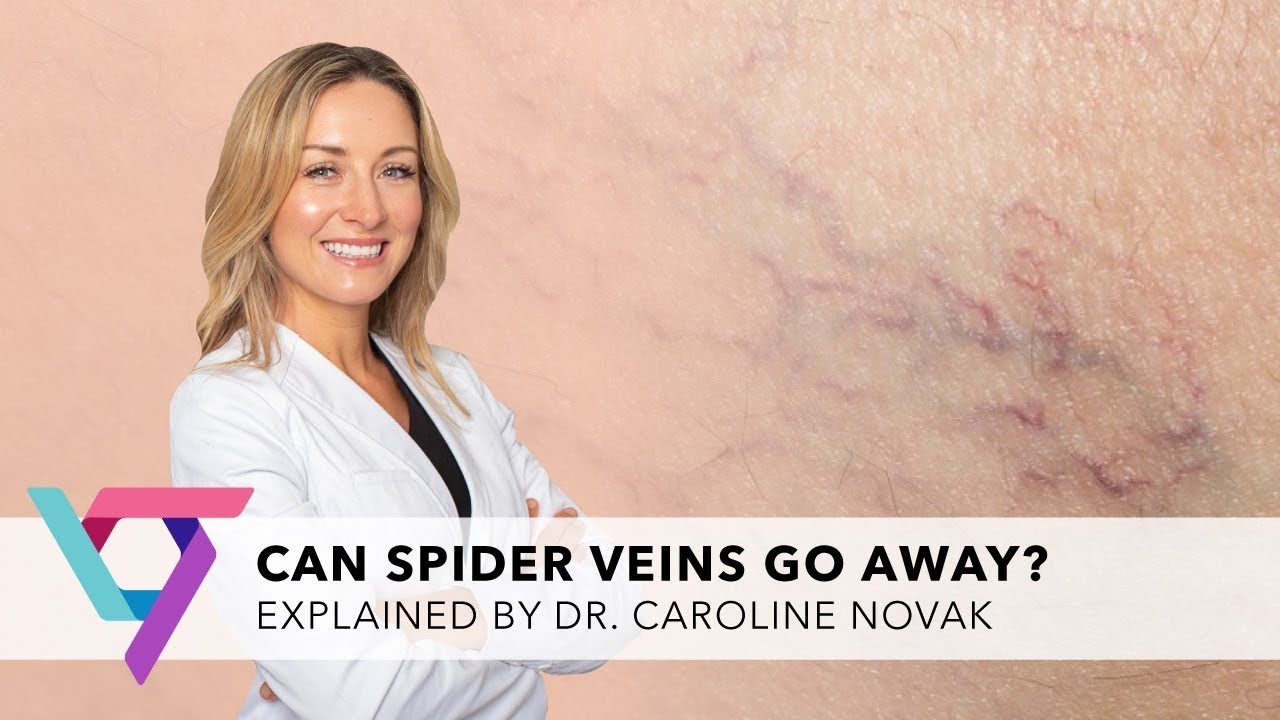 Medical Clinic: Can Spider Veins Go Away? | Vein Treatment Center Manhattan 10016