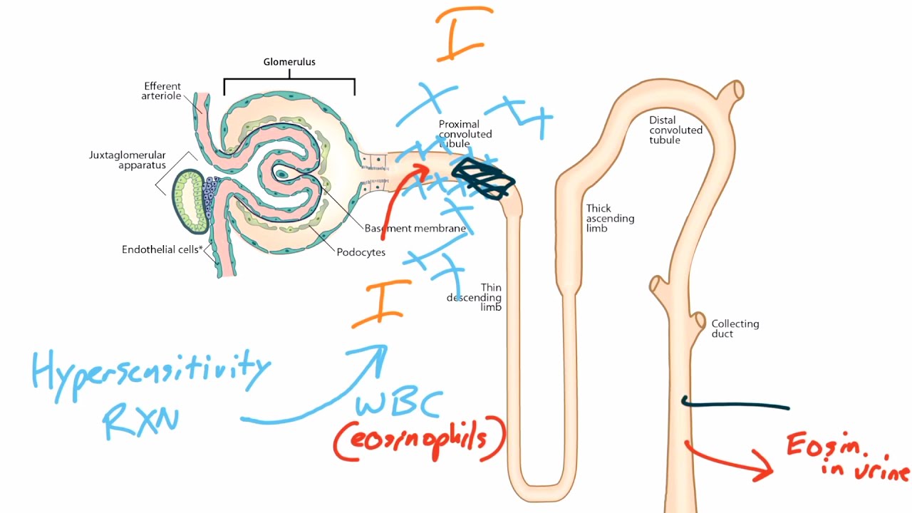 Acute Kidney Injury for the USMLE Step 1
