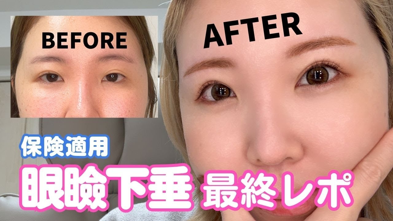 【眼瞼下垂】手術して8ヶ月、最終レポだよ【保険適応】