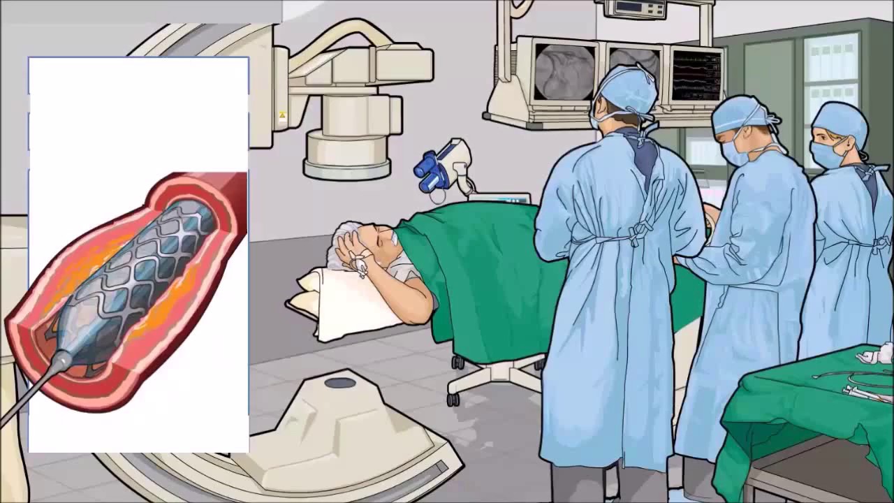 Koronarangiographie und Einsetzen eines Stent in die Herzkranzarterien