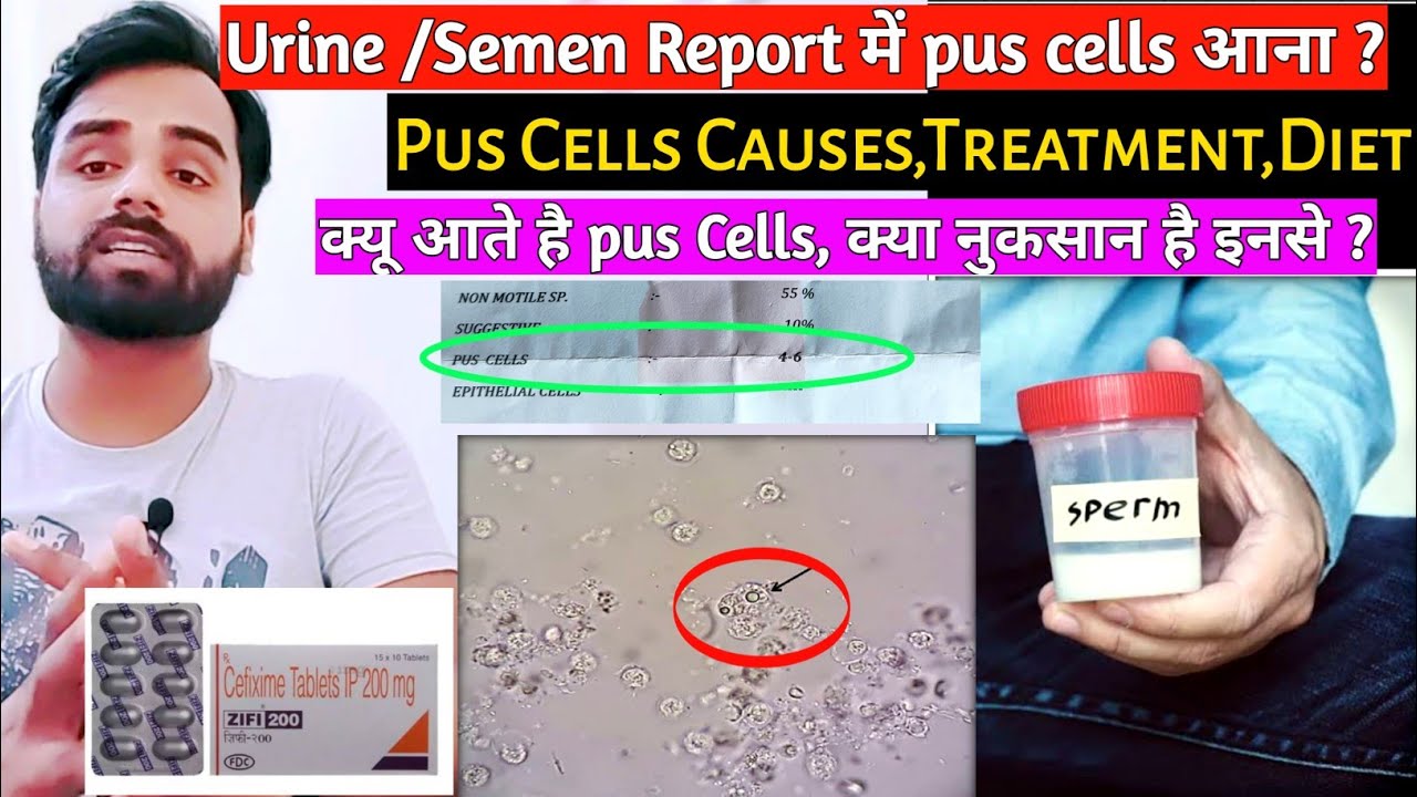 Pus cells Treatment || Urine या Semen में Pus cells का इलाज कैसे करे ? || Medical jankari