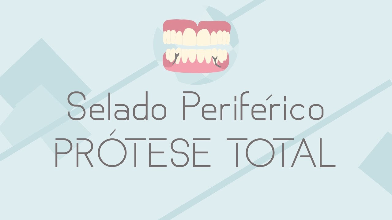 SEQUÊNCIA CLÍNICA Moldagem do selado periférico superior (PT)