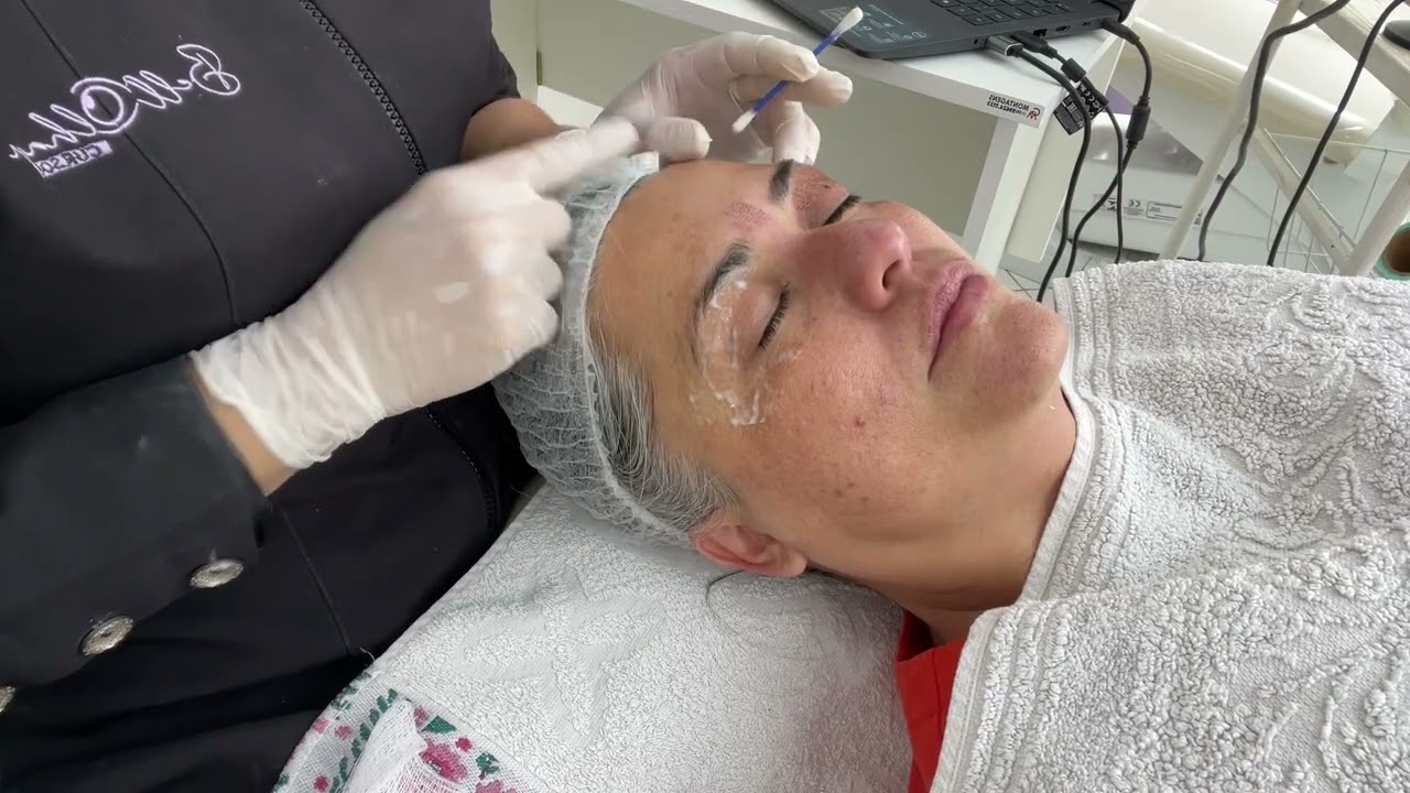 Aula de rejuvenescimento da área dos olhos e glabela com jato de plasma