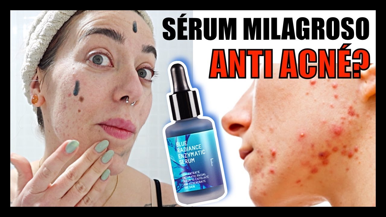 💚6 productos NATURALES para ELIMINAR el ACNÉ y la PIEL GRASA | Rutina Freshly Cosmetics