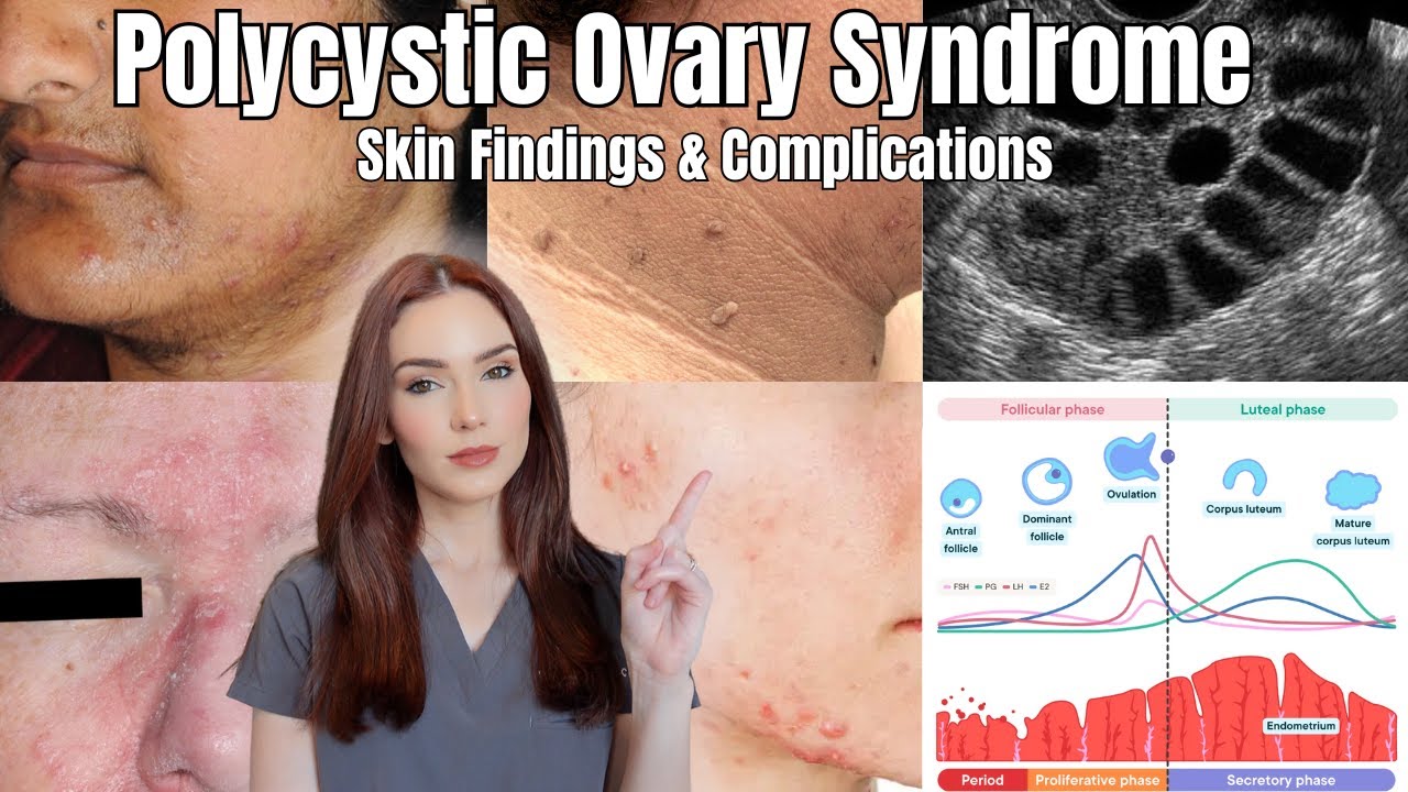 Polycystic Ovary Syndrome (PCOS) & Skin Findings | A Deep Dive