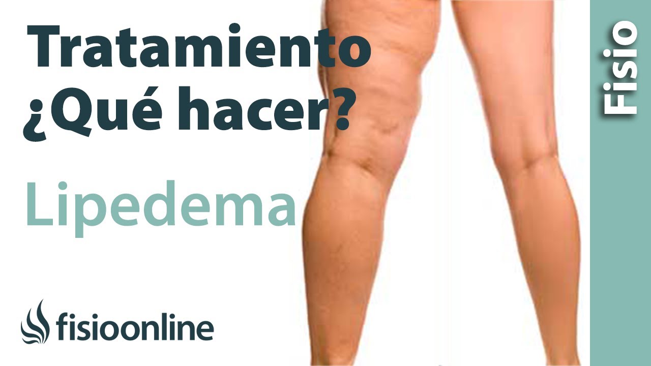 TRATAMIENTO para el LIPEDEMA🦵🏻 ¿Qué hacer?🤔