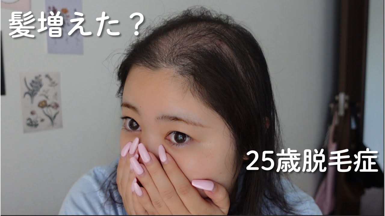 最近の薄毛事情👩‍🦲♡