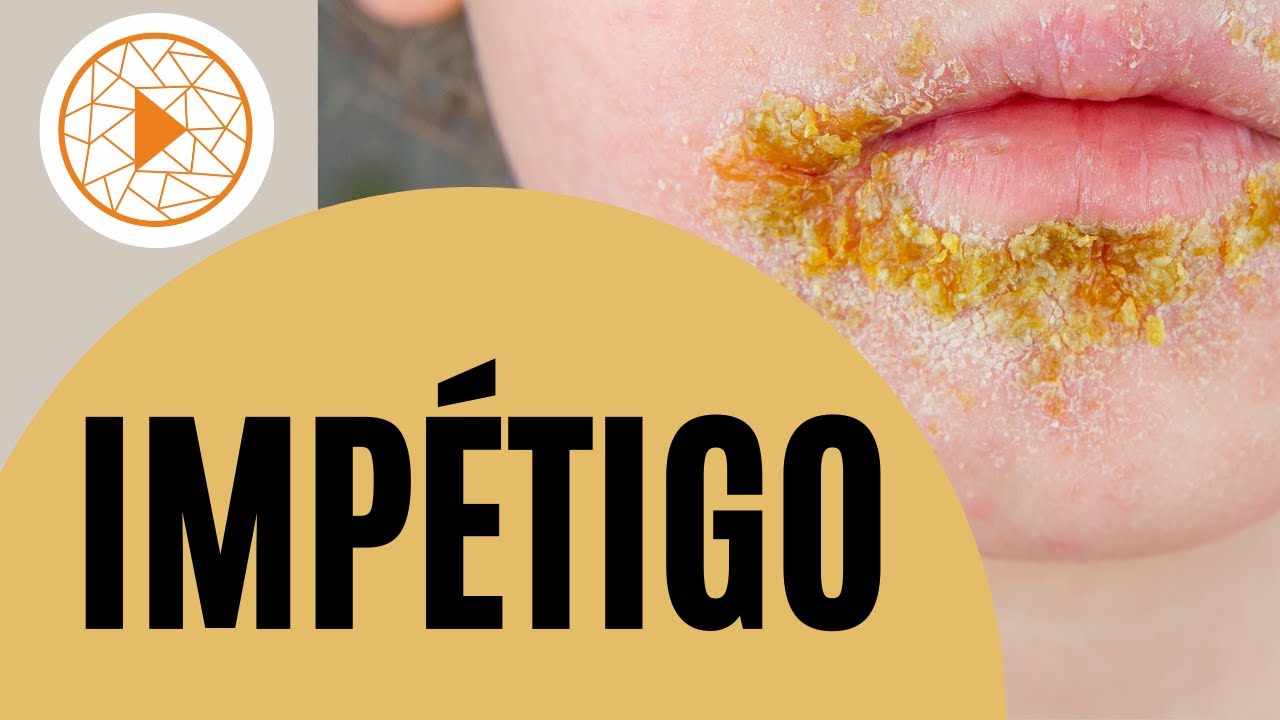 IMPETIGO | ¿Qué es? Descubre los síntomas y su prevención