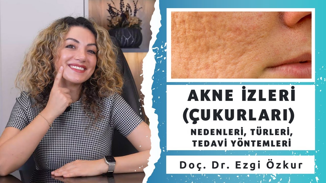 Akne İzleri (Çukurları) Nasıl Oluşur? Türleri ve Tedavi Yöntemleri Nelerdir?