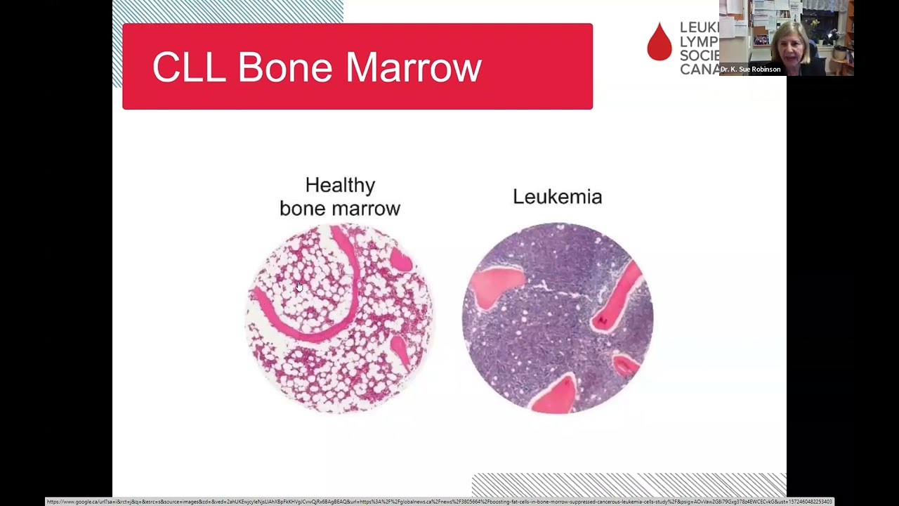 Chronic lymphocytic leukemia (CLL): What it is when to treat and what’s ahead