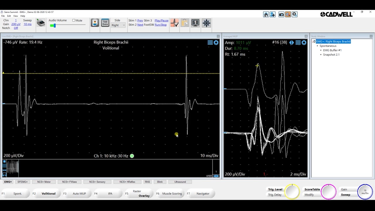 EMG+ Basic Functions  Cadwell Sierra Summit 3 1