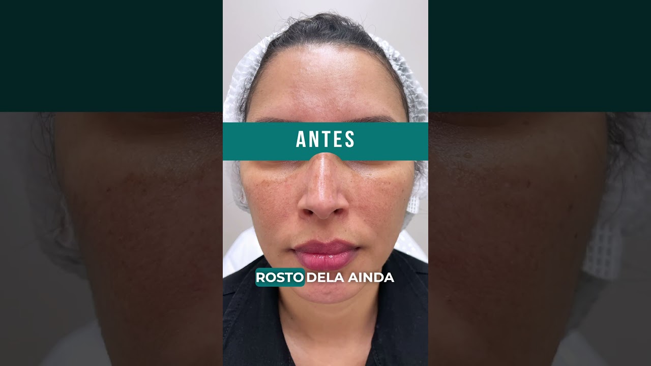 Melasma: Tratamento com Laser Fotona StarWalker #melasma #dermatologia #estetica #cuidadoscomapele