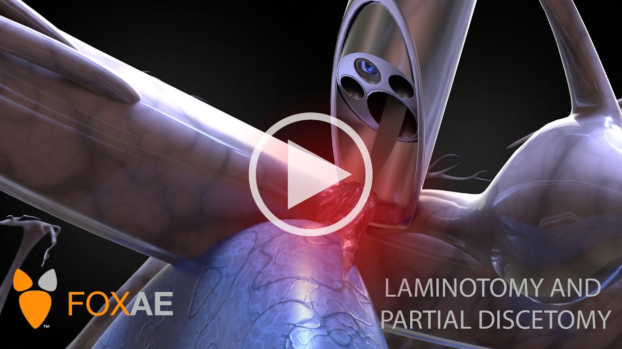 Laminotomy and Partial Discectomy | Legal Animation | Surgery Demonstration
