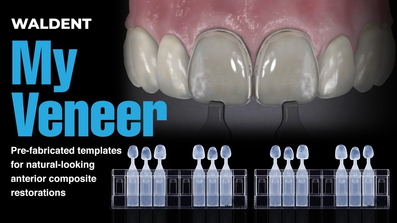 Pre-fabricated templates for natural-looking anterior composite restorations | Waldent My Veneer