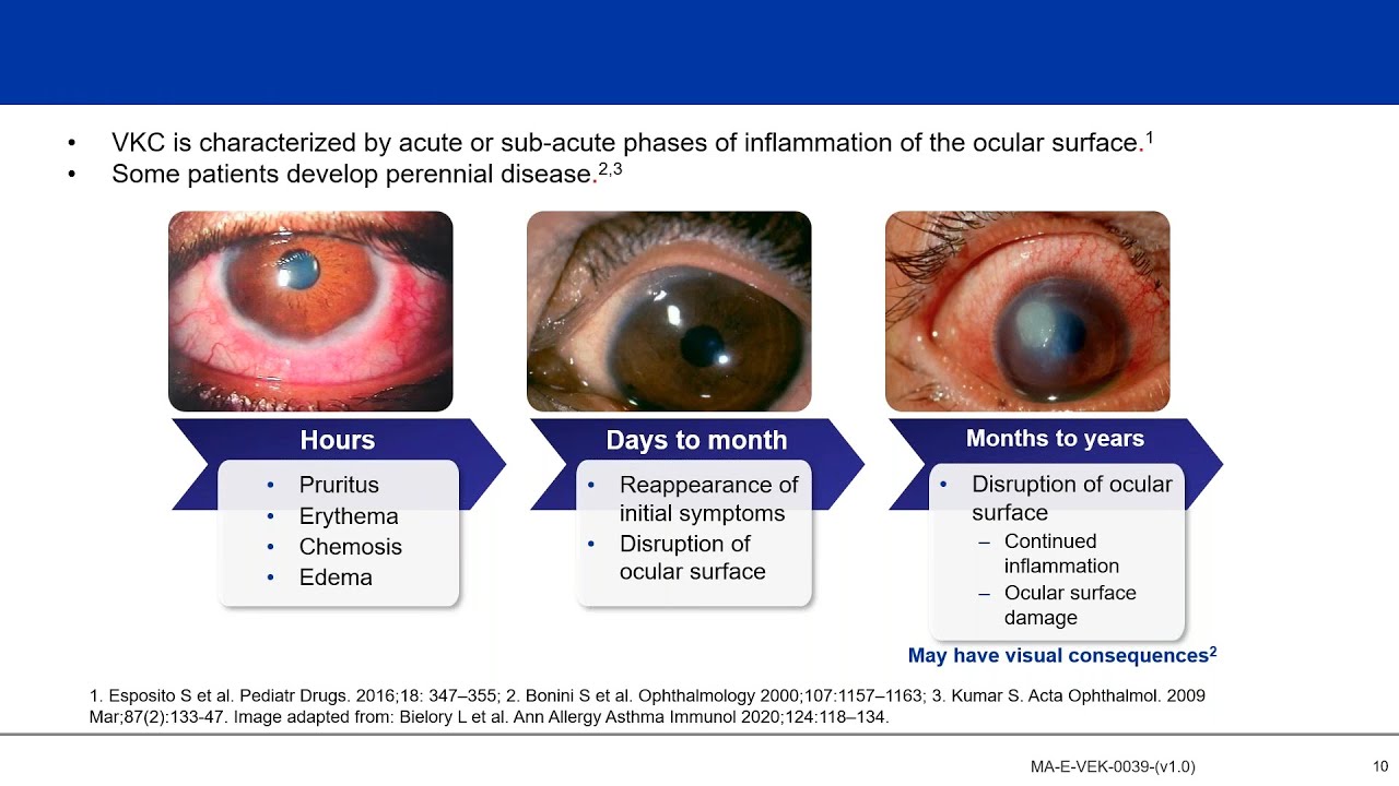 Understanding Vernal Keratoconjunctivitis (VKC): Not &ldquo;Just an Allergy&rdquo;