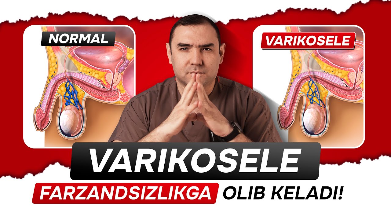 Sizga Varikosele tashxisi qo'yildimi? Varikosele farzandsizlikga olib keladi!