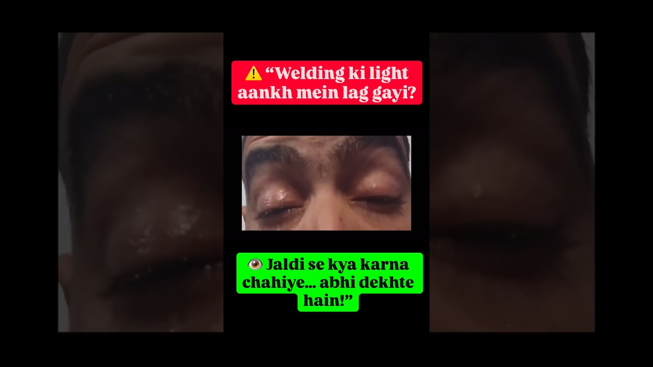 ⚠️ Welding Flash Burn in Eye (Arc Eye) | Quick Relief & Prevention | Jaipur Eye & Dental Hospital