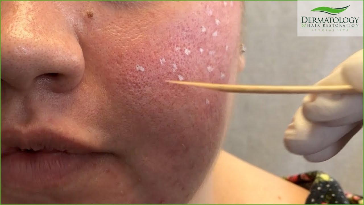 ACNE SCAR Treatment - TCA Cross - Los Angeles