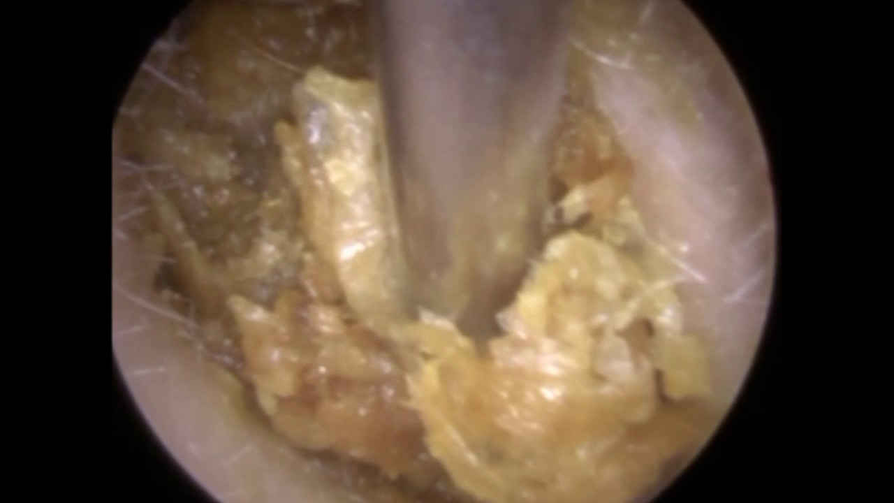 Golden Ear Wax Removal from Ear - Mr Neel Raithatha (The Hear Clinic)