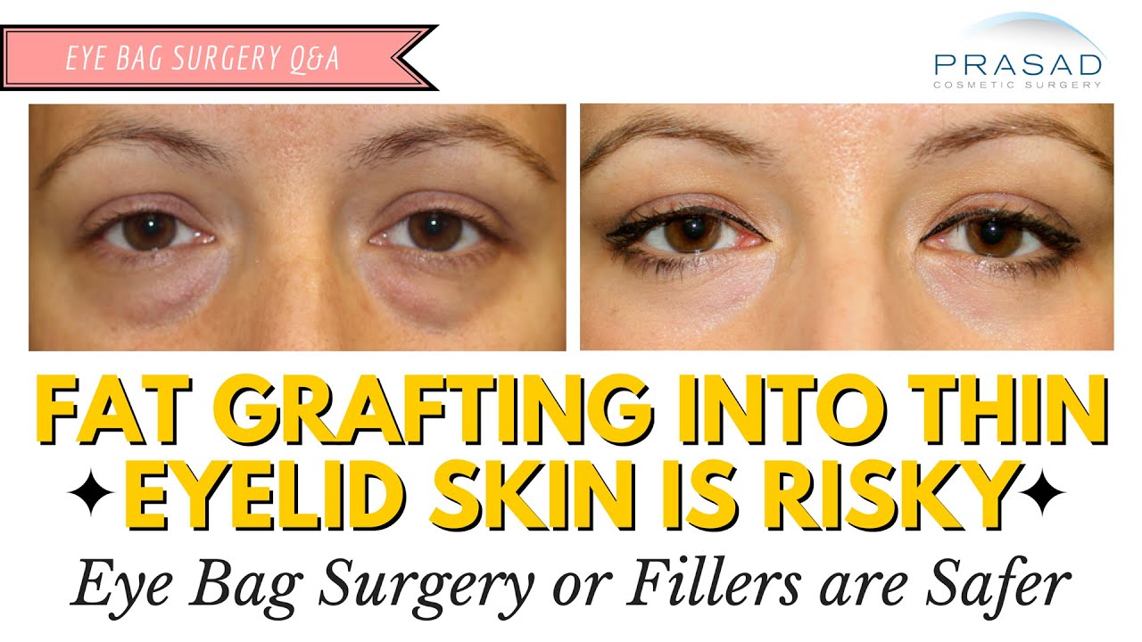Fat Grafting is Not Advised in Thin Eyelid Skin - Safer Options for Eye Bag Treatment
