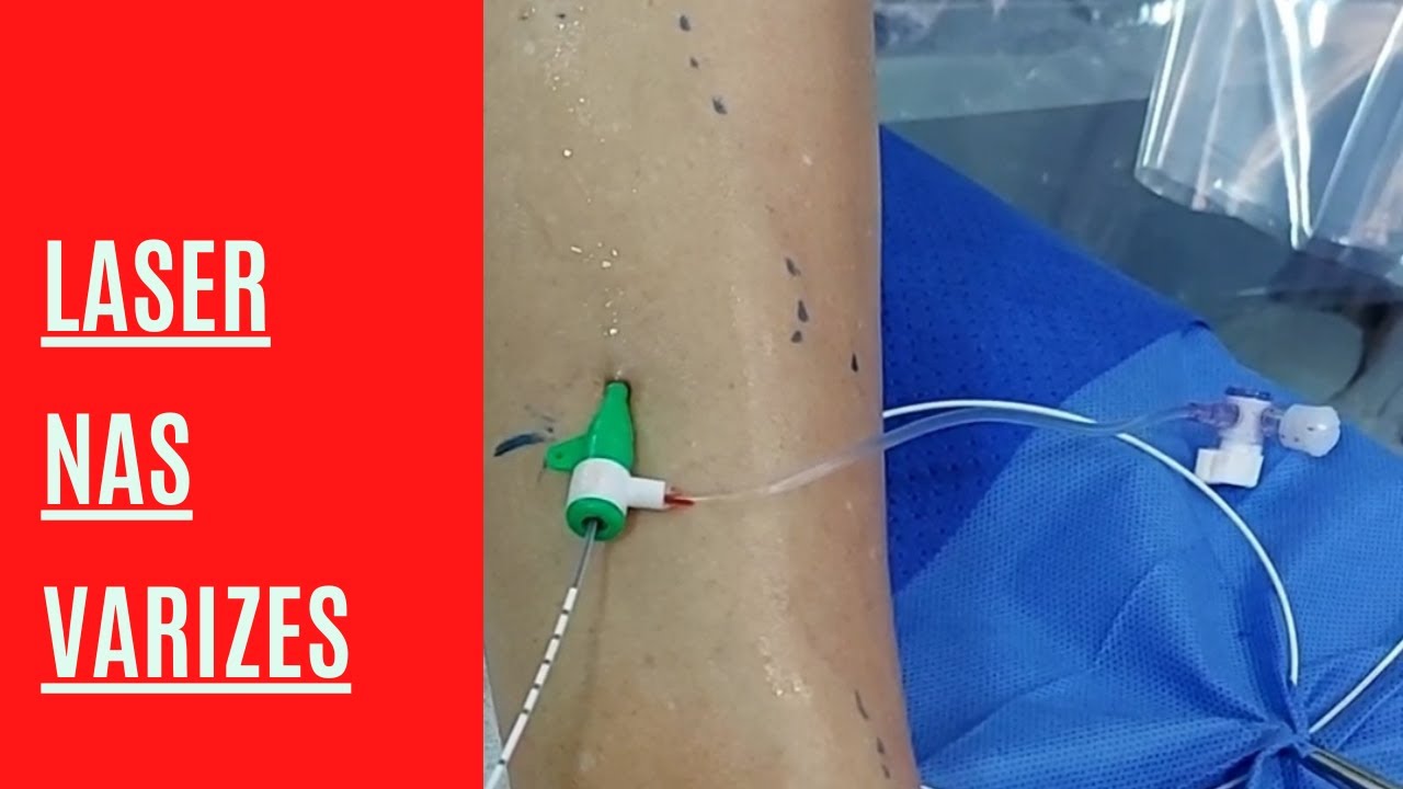 Efeito do LASER nas veias varicosas - Como o LASER age nas veias.