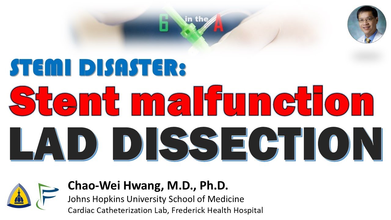 STEMI Disaster: Stent malfunction, LAD Dissection, and Stent Loss