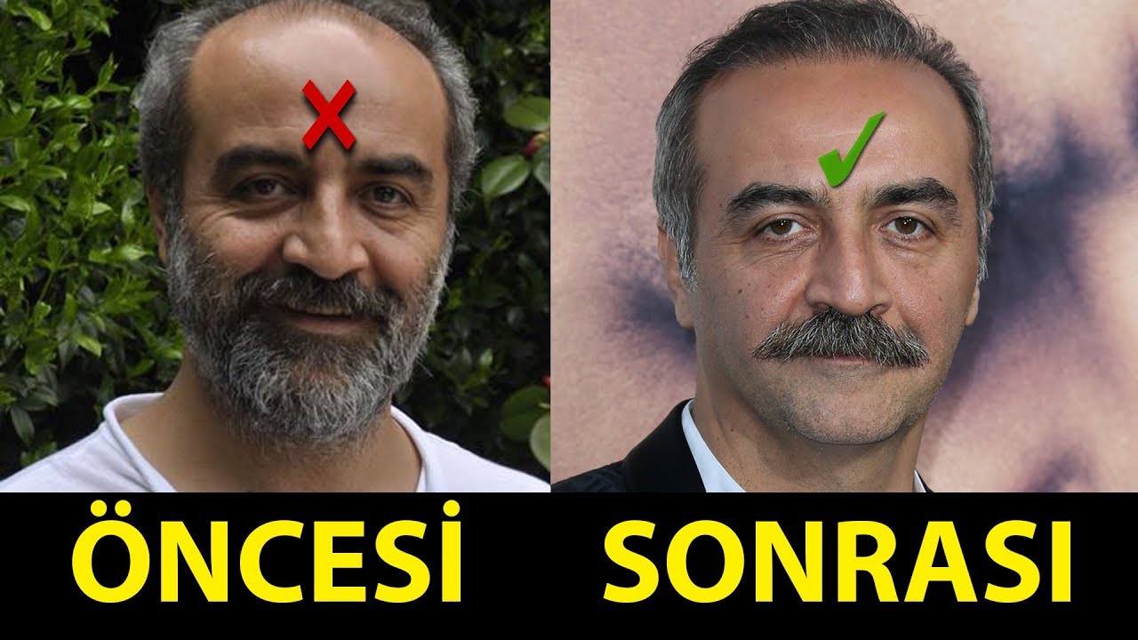 Saç Ektiren ve Protez Saç Kullanan Ünlüler (Öncesi - Sonrası)