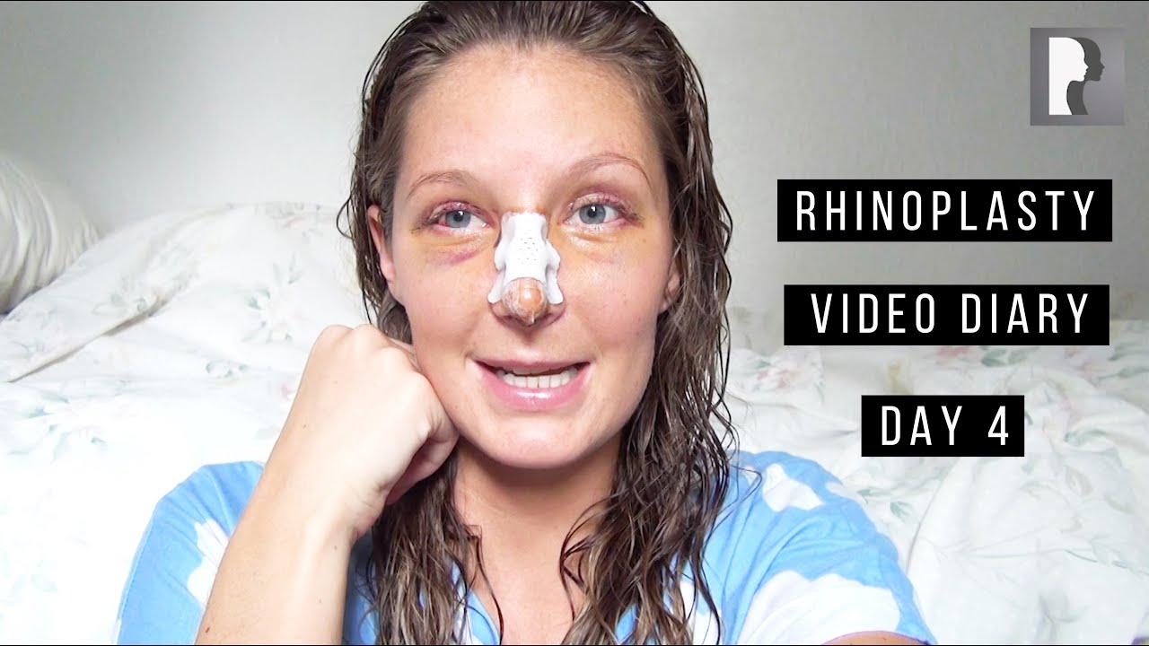 Rhinoplasty Video Diary - Day 4 After Surgery (3 of 15)