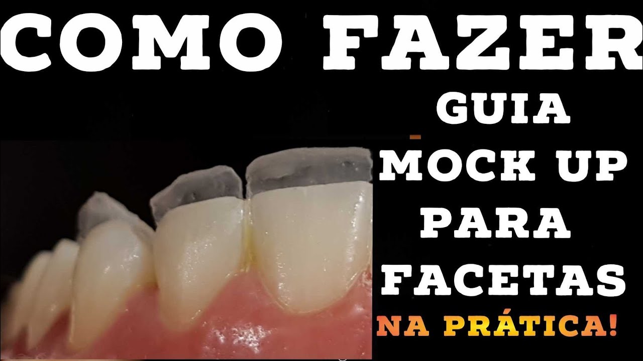 🛑COMO FAZER UMA GUIA MOCK UP PARA FACETAS EM RESINA🤫✍NA PRÁTICA!