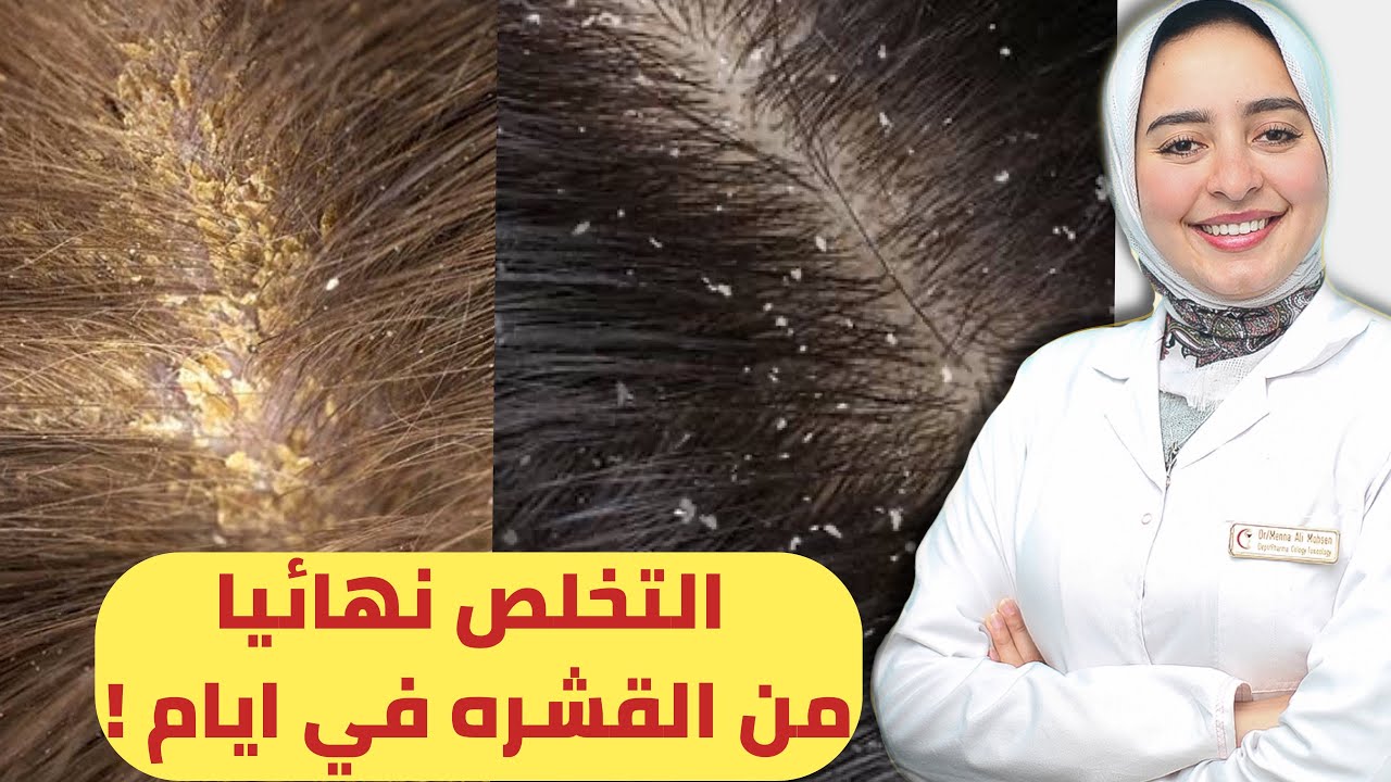 روشتة اقتصاديه لعلاج قشرة الشعر نهائيا ومنع ظهورها فالشتاء ❌
