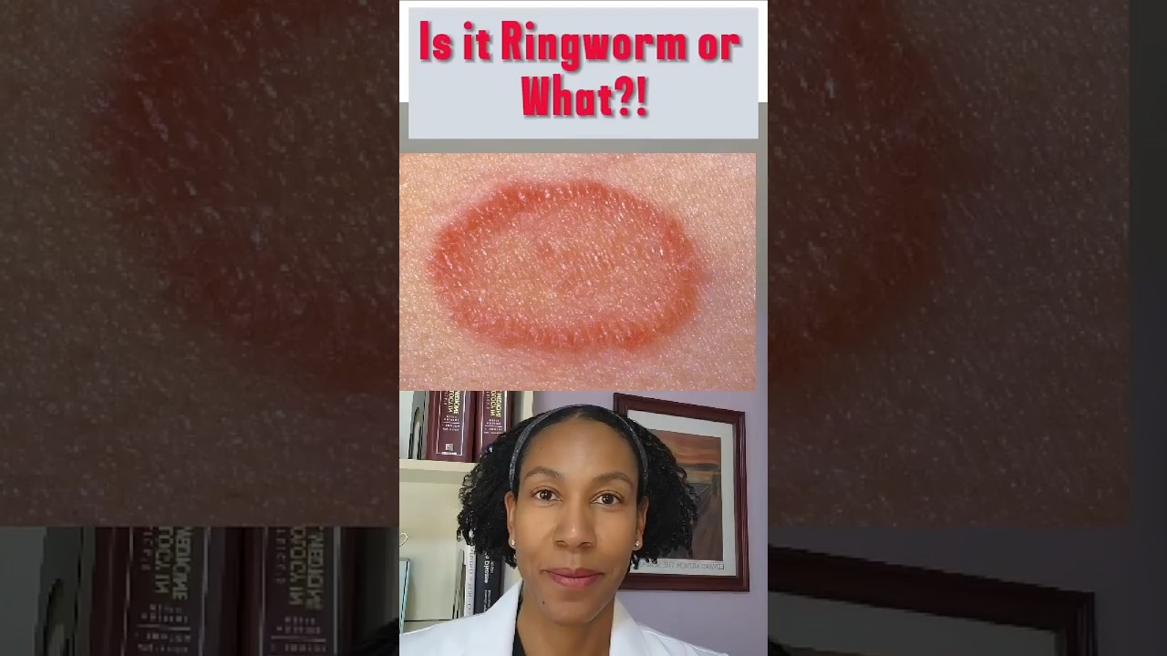 This is  NOT RINGWORM! Ringworm cream won't work! #skincare #skincondition