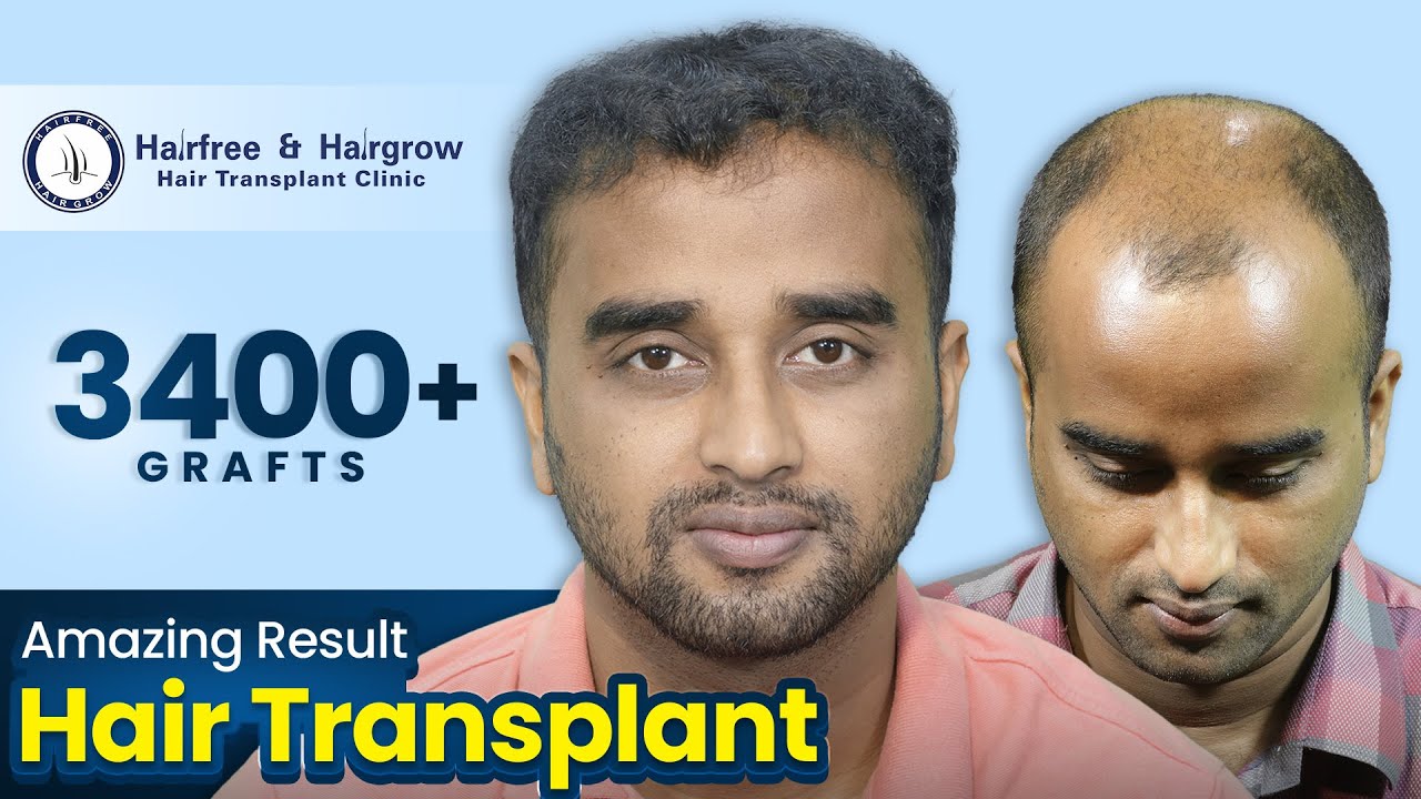 Grade 3A Hair Transplant Before & After | Real Results in Bangladesh (Sapphire FUE)