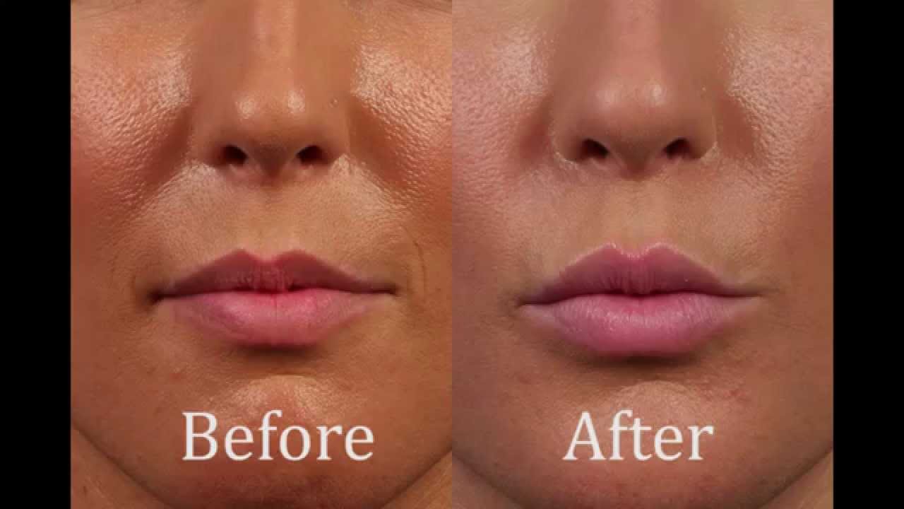 I had lip filler with Dr. Kotlus