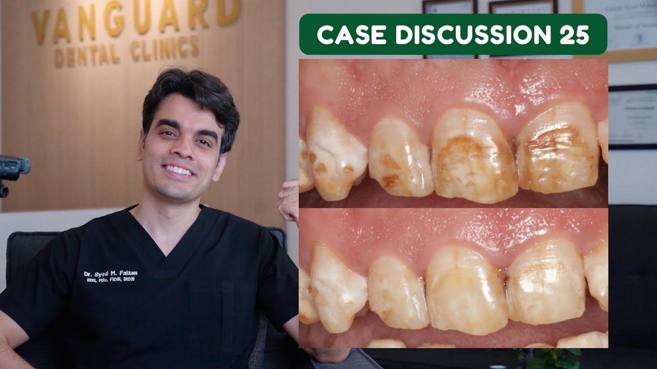 Fluorosis Treatment/Microabrasion  - Case Discussion 25